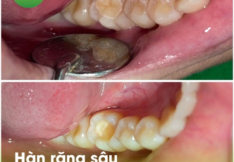 Hàn răng sâu cho bé giá bao nhiêu